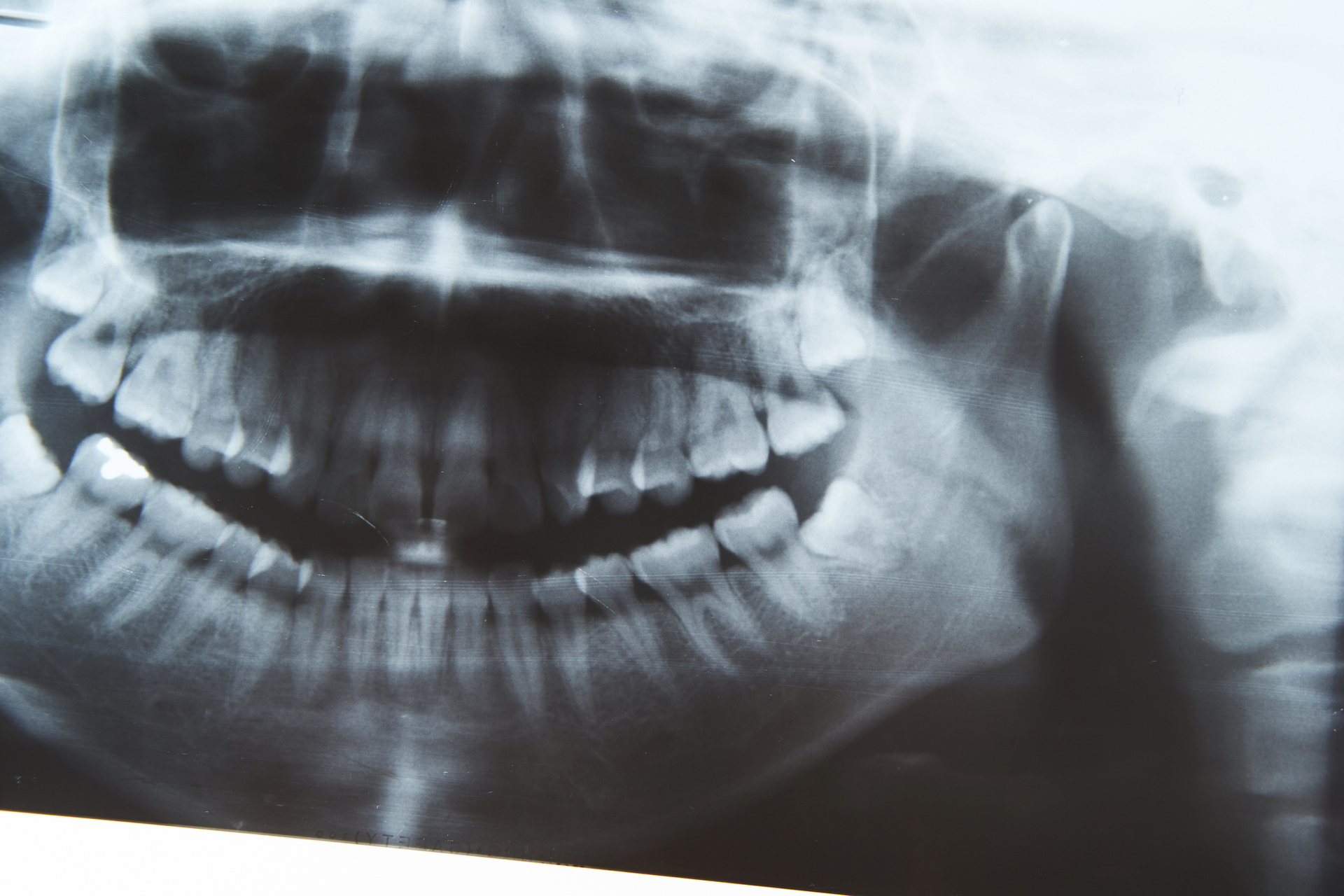 補綴治療（保険診療）