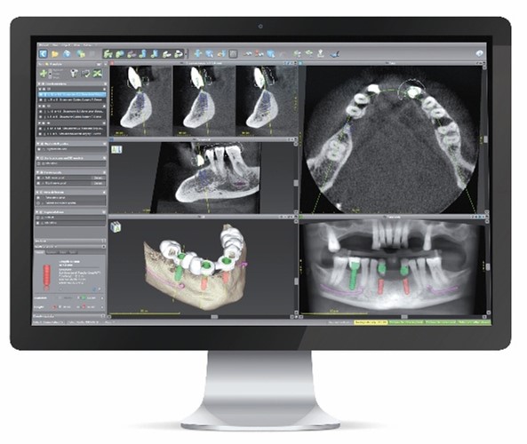 インプラント治療